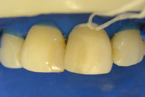 Restauração do elemento 21 (V)