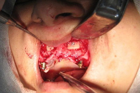 Enxerto Autógeno para Reconstrução de Maxila - Área Doadora: Mento.