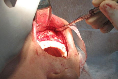 descolamento músculo mentual