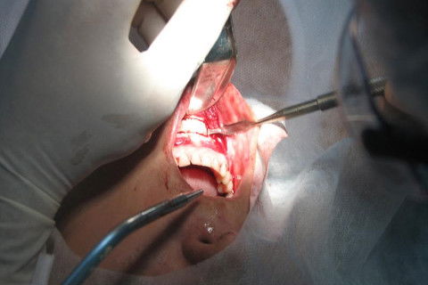 bloco ósseo sendo removido