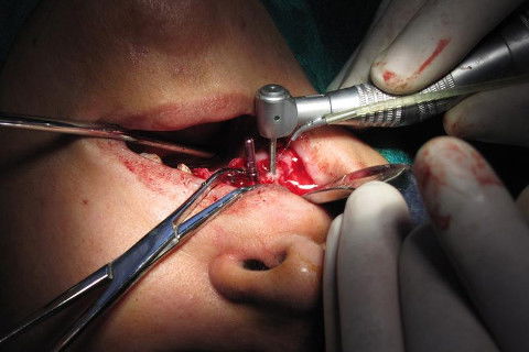 instalação dos implantes - média de 60 N