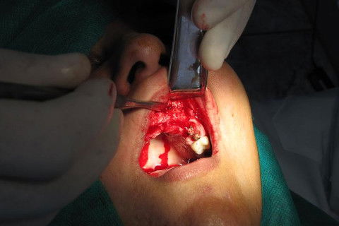 retirada dos parafusos de fixação