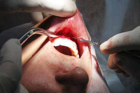 acesso a área doadora - região do mento