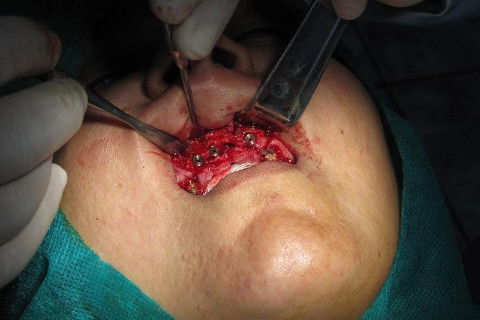 implantes instalados com sucesso