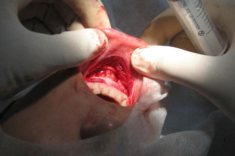 área doadora após a remoção do bloco