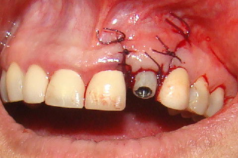 Coroa Unitária Metal Free Sobre Implante