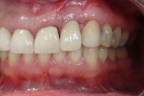 Coroa Unitária Metal Free Sobre Implante