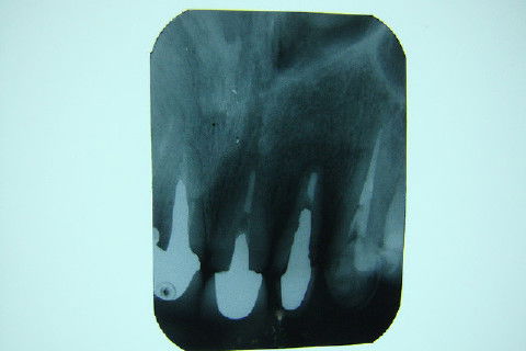 Coroa Unitária Metal Free Sobre Implante