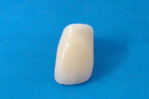 Coroa Unitária Metal Free Sobre Implante