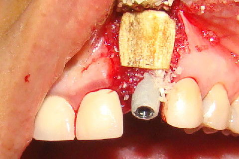 Coroa Unitária Metal Free Sobre Implante