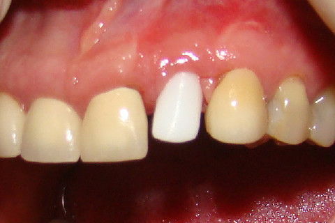 Coroa Unitária Metal Free Sobre Implante