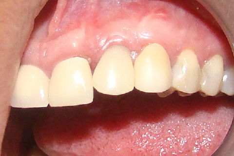 Coroa Unitária Metal Free Sobre Implante