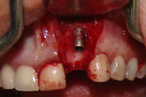 Coroa Unitária Metal Free Sobre Implante