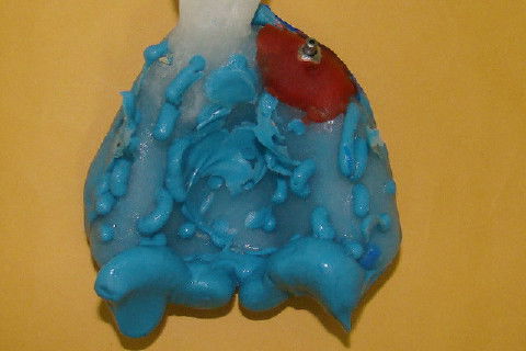 Coroa Unitária Metal Free Sobre Implante