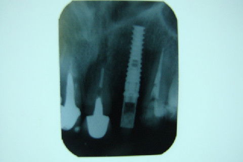 Coroa Unitária Metal Free Sobre Implante