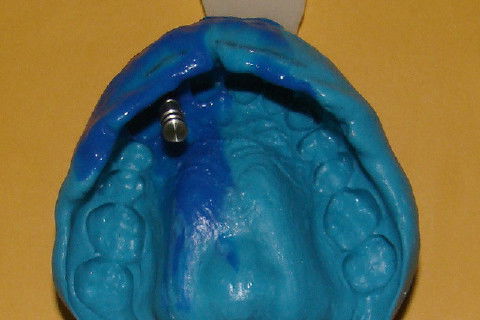 Coroa Unitária Metal Free Sobre Implante