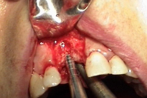 Utilizando osteotomos para expansão da cavidade óssea