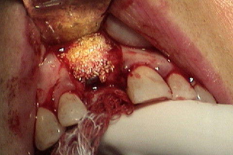 Enxerto com tecido ósseo xenogeno