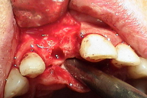 Perfuração terminada, pronta para inserção do implante