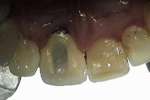Vista palatina, com o orificio de acesso ao parafuso retentor restaurado