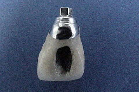 Vista palatina da coroa metalo-ceramica