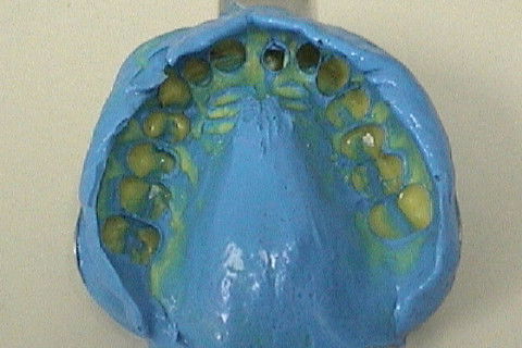 Moldagem de arco total, com moldeira de estoque