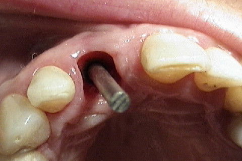 Vista oclusal do mesmo parafuso