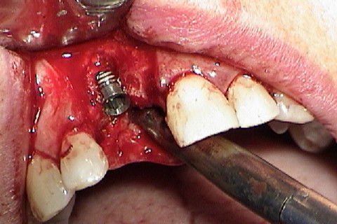 Implante colocado, com algumas expiras expostas e necessitando de enxerto