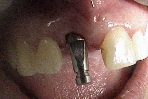 Colocação de transfer para moldeira fechada ou de estoque