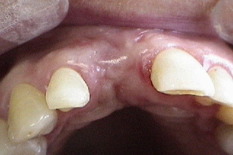 Vista oclusal no momento da reabertura cirúrgica(6 meses após)