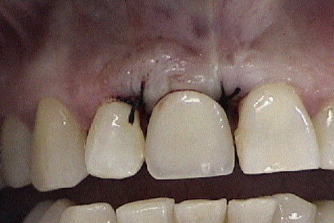 Protese removivel que a paciente utiliza até a finalização do caso