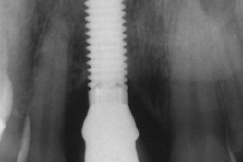Implante Unitário: Cirurgia e Prótese