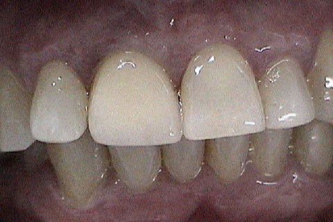 Aspecto da coroa metaloceramica no elemento 11