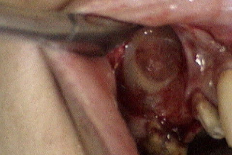 Colocação do PRF, cobrindo a área enxertada