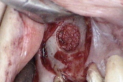 Preenchimento total do espaço criado com a elevação do soalho do seio maxilar