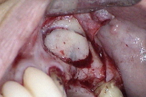 Delimitação da janela óssea