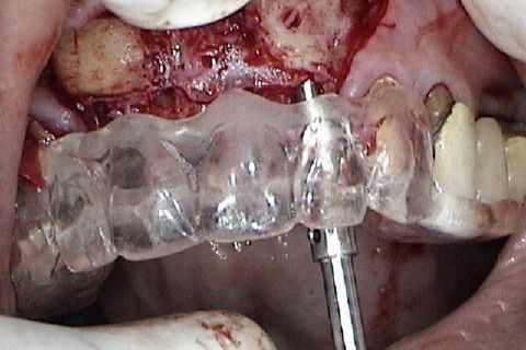 Marcação atraves do guia cirúrgico das posições dos implantes