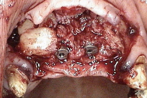 Vista oclusal dos 4 implantes colocados