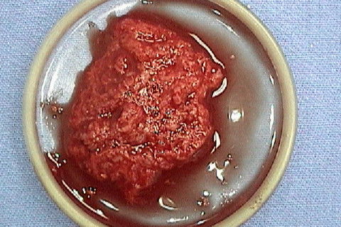 Aspecto do enxerto ósseo particulado após geleificação do PRP