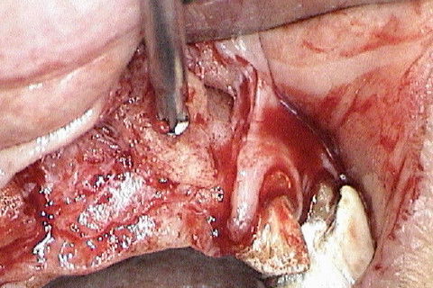 Abertura do retalho e inicio da remoção dos parafusos de osteossíntese na região 22