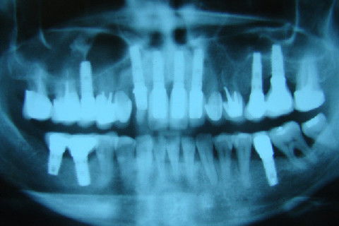 Radiografia panoramica após o termino do tratamento