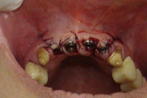 Sutura dos pediculos e incisões horizontais e verticais