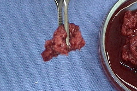 A adição do PRP aglutina o enxerto e facilita sua manipulação e acomodação na área receptora