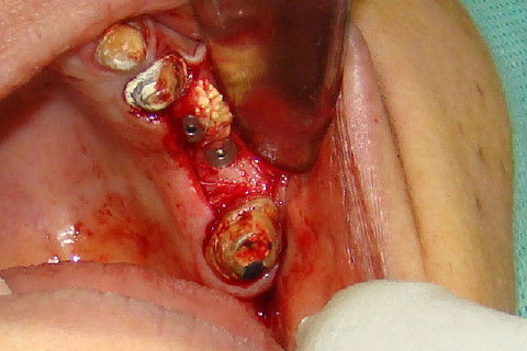 Colocação de implantes na região 25 e 26
