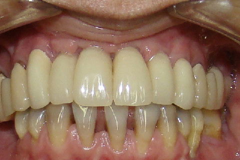 Colocação de proteses temporarias superiores enquanto aguardamos o tratamento ortodontico