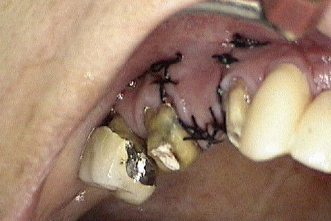 Sutura da região enxertada