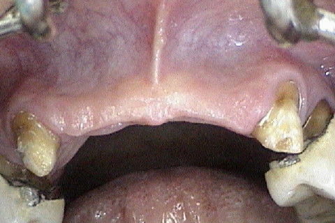 Aspecto clinico da região anterior maxilar, após remoção das proteses antigas