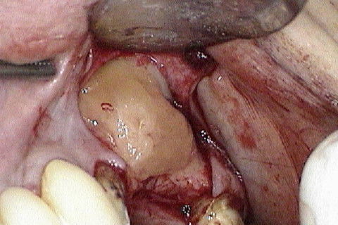 Colocação do PRF, cobrindo a área enxertada