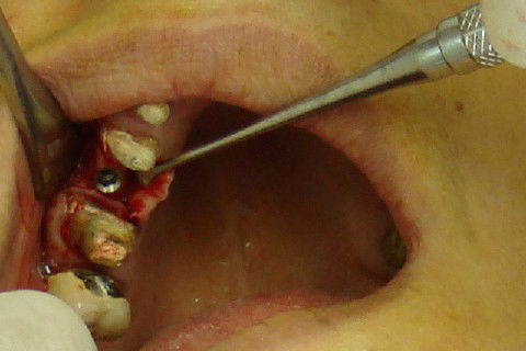 Colocação de implante na região 15