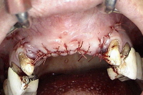 Sutura da região anterior da maxila